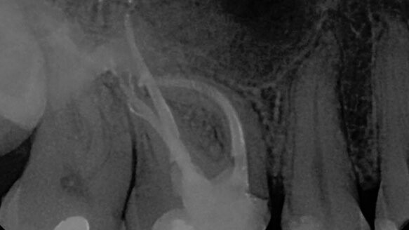 DENTSPLY Tulsa announces winners of GuttaCore University Challenge