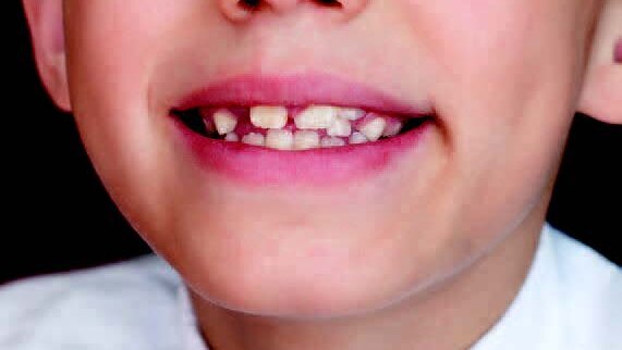 Οι συγκλεισιακές ανωμαλίες επηρεάζουν τη στάση του σώματος και την ισορροπία