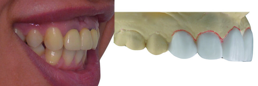 Fig. 7 : Wax-up, vue latérale.