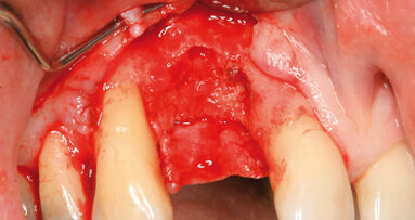 Traitement implantaire de sites édentés