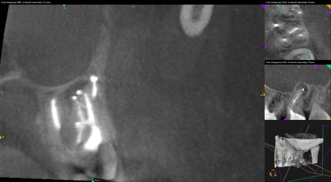 Fig. 26: Post-op CBCT image showing two portals of exit in the mesiobuccal root of the second molar, one isthmus in the medial part and one isthmus in the apical part of the mesiobuccal root, and part of the palatal and distobuccal roots.