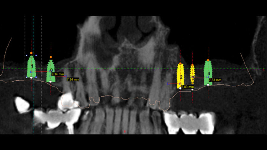 Obr. 14a, b: Digitální plánování implantátu: 2D (a) a 3D (b).