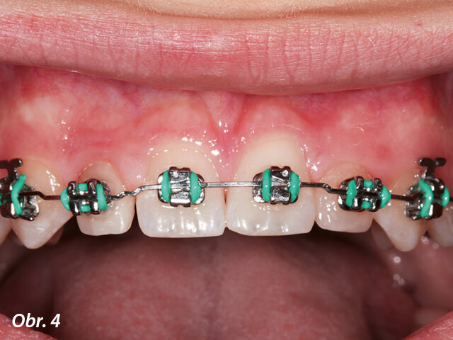 Drobné laterální řezáky u 1. případu.