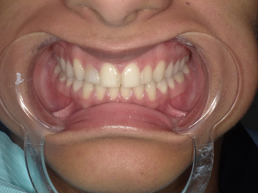 Fig 2: Pre-operative retracted  view
