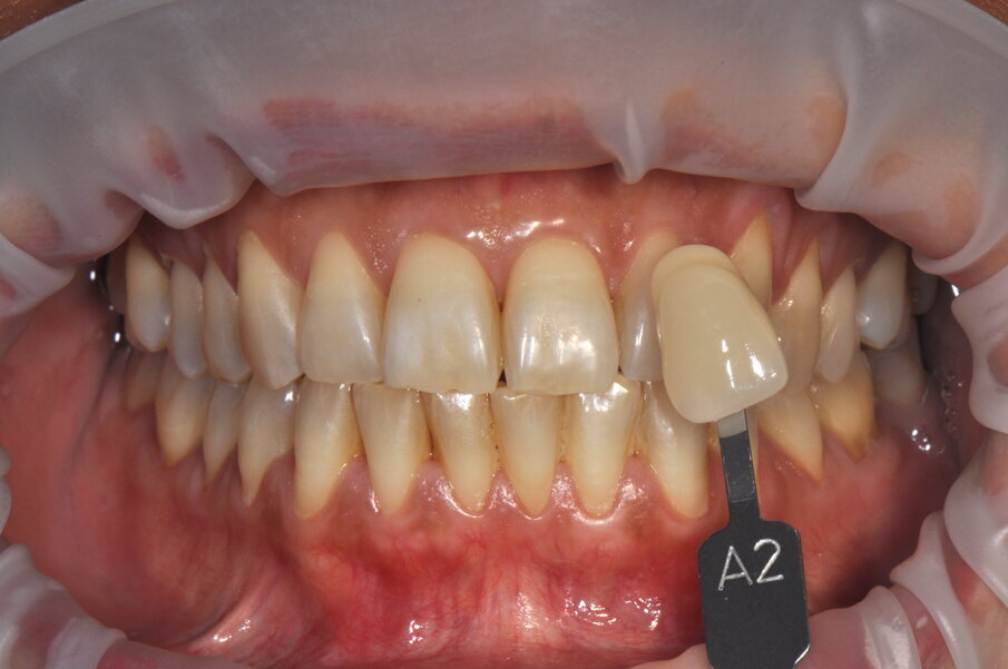 Fig. 1 - Fotografia frontale scattata prima della seduta di igiene professionale (Guided Biofilm Therapy) rilevazione del colore a tempo zero, utilizzando la scala colore “Vita”.