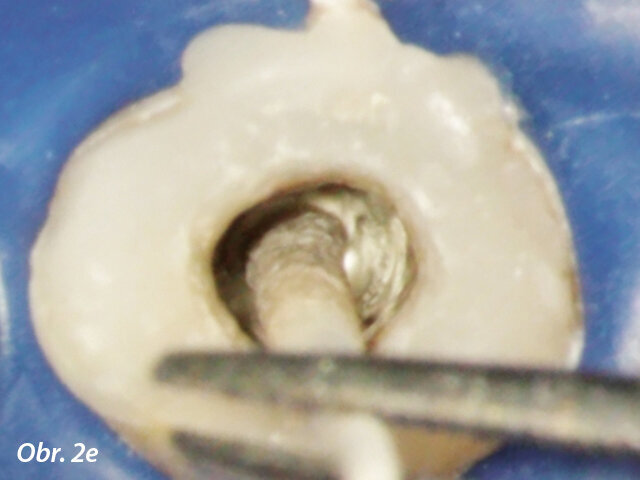 Kondenzace MTA papírovým čepem