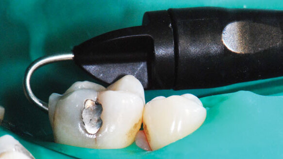 Sulzer Mixpac 1 ml system delivers big on flexibility