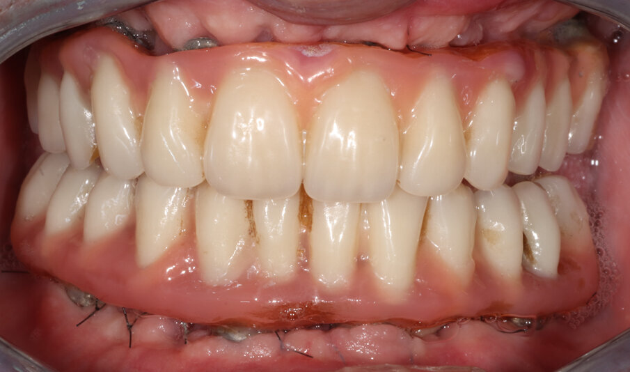 Fig. 7_Controllo dell’occlusione delle protesi provvisorie appena consegnate al paziente.