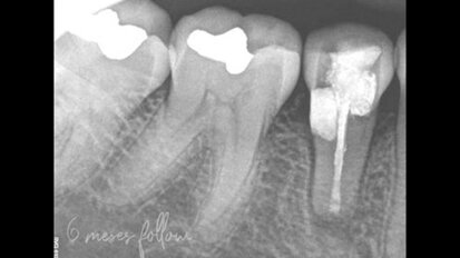Riassorbimento della radice cervicale esterna nella zona mandibolare anteriore: diagnosi e alternative terapeutiche