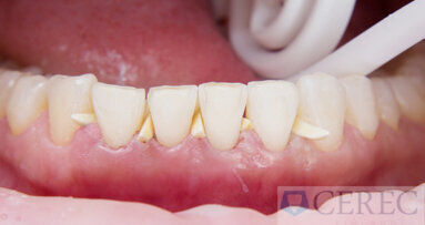 Kombinace CAD/CAM – assisted treatment pro nový krásný úsměv