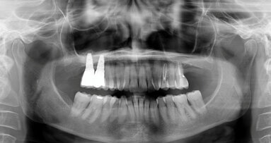 Sinus lift surgery in severely resorbed  maxillae: One-year follow-up