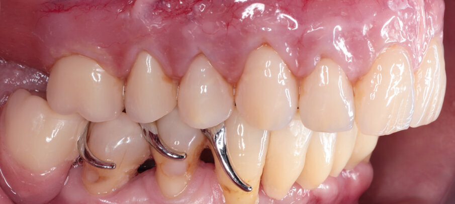 Figs: 11. Upper and lower dentures in situ. The customized pink and white esthetic effects make the dentures look very natural – the teeth look as though they have grown from the gums like natural teeth.