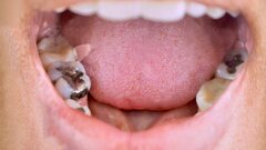 WHO advances action on dental amalgam phase‑out across Southeast Asia