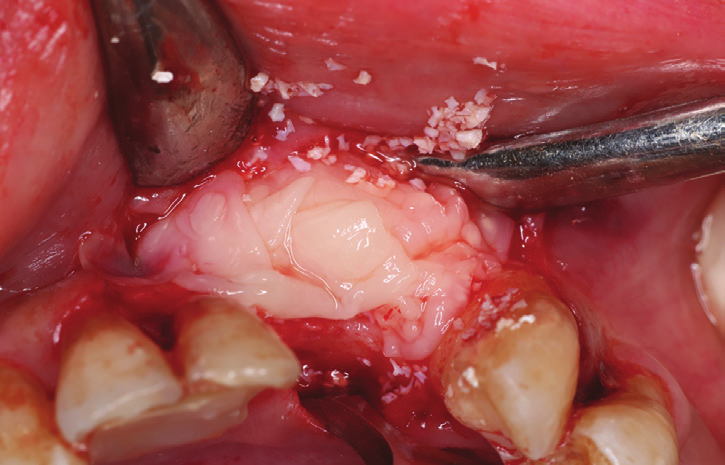 Figure 8: Final layer of coverage formed by L-PRF mem- branes covering the cross-linked collagen membrane.