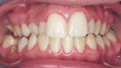 Tongue Star 2 (TS2) – systém pro rychlou léčbu otevřeného skusu