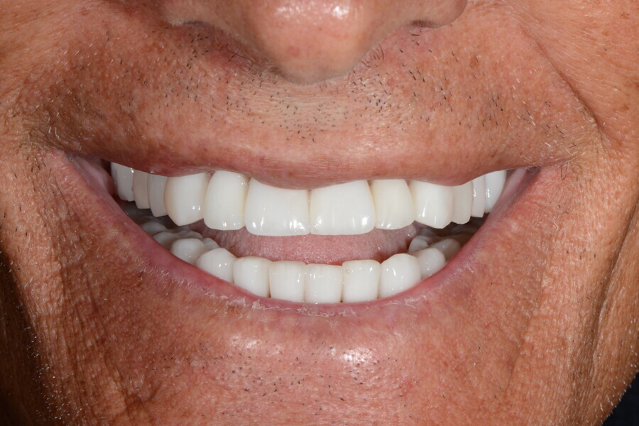 Fig. 32b: Frontal view of the patient’s smile, mouth open.