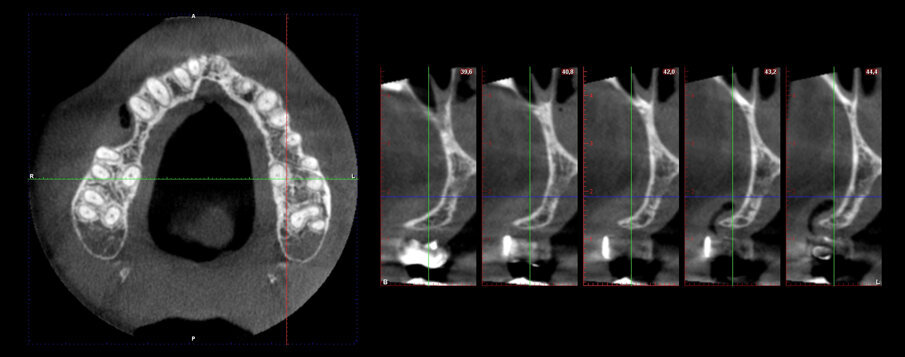Fig. 4 - Forte perdita ossea vestibolare.
