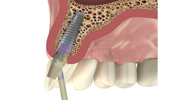 Un nuevo pilar que puede colocarse en distintos ángulos