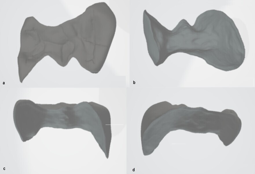 Figs. 10a–d: Virtual inlay from the occlusal view (a), intaglio view (b), palatal view (c) and buccal view (d).