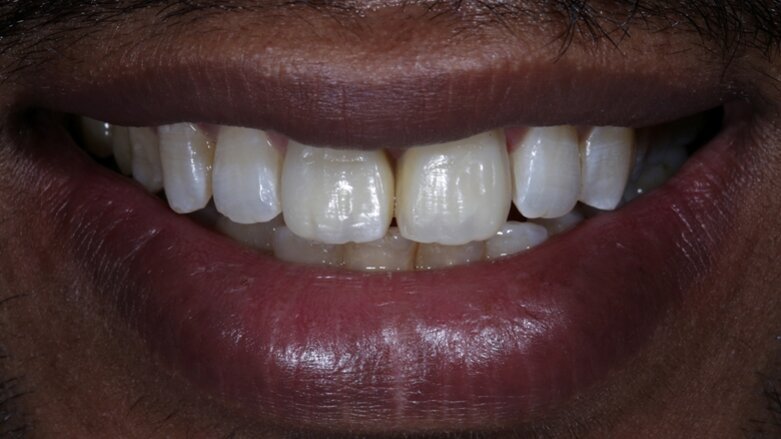 Bringing anterior direct composite restorations to life with histologic layering protocols