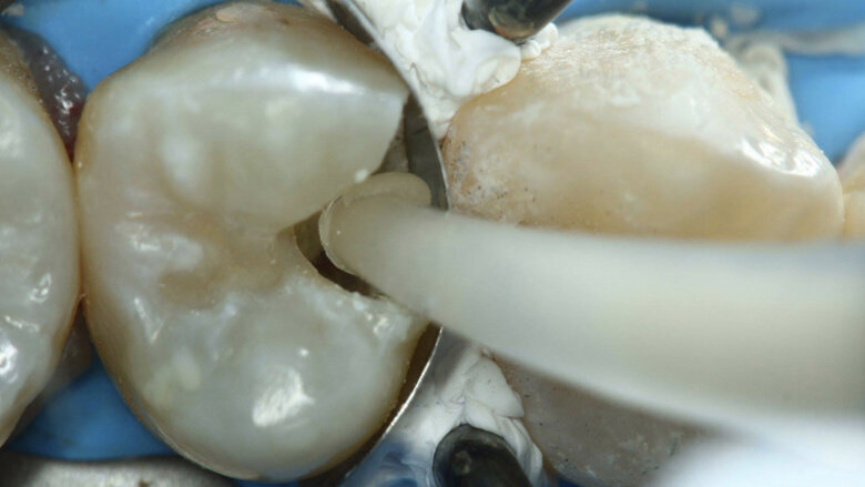 Figuras 29 y 30. Se inyecta el ionómero en la pieza 25.