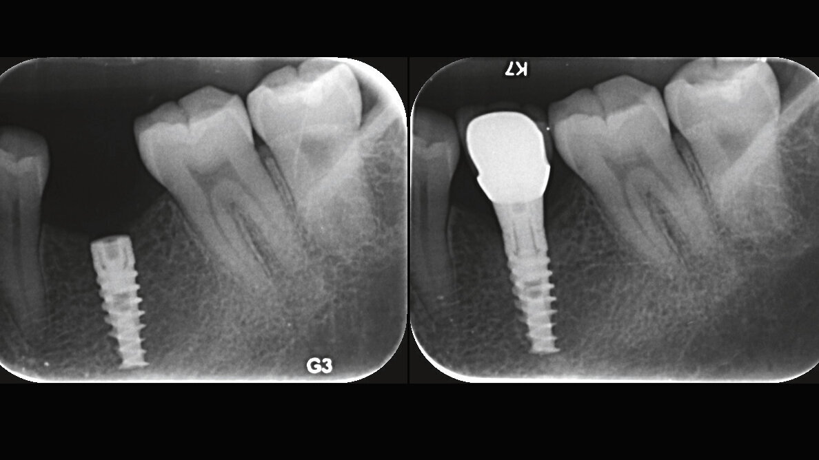 Low implant insertion torque allows minimal bone loss: A multicenter two-year prospective study