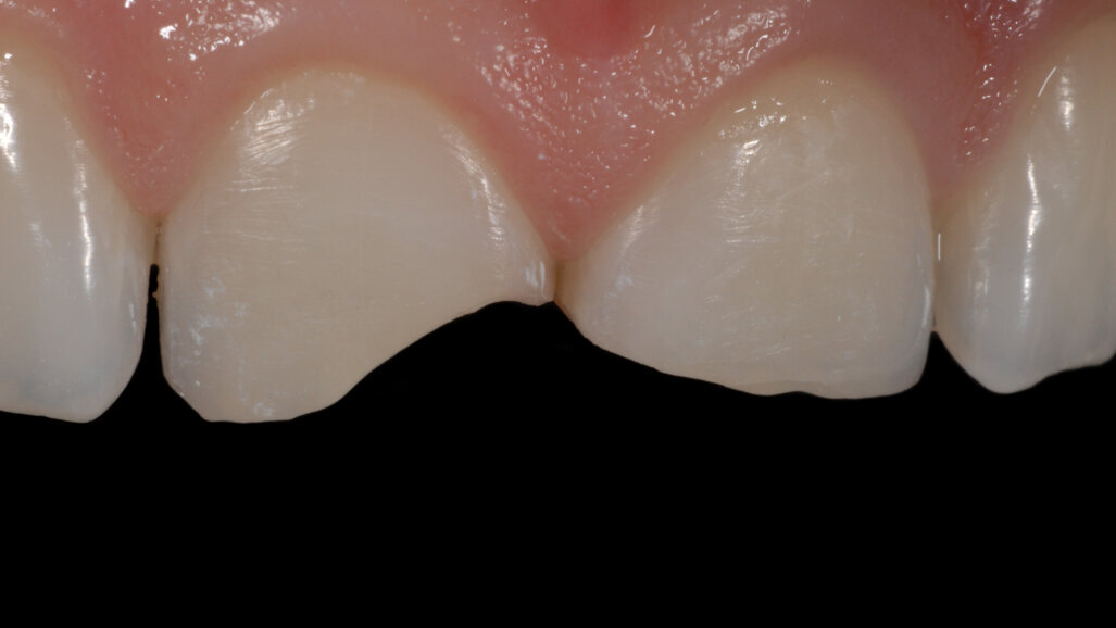 Un nuevo concepto en la estratificación con resinas compuestas