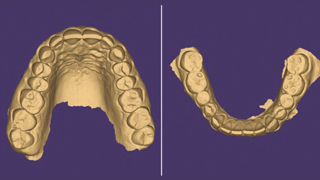 Workflow digitale  in gnatologia. Caso clinico