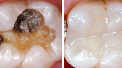 Seitenzahnfüllungen: Aktuelle Trends für Adhäsive und Bulkfill-Technik