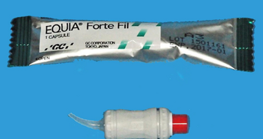 Las ventajas de los ionómeros de vidrio de alta viscosidad reforzados