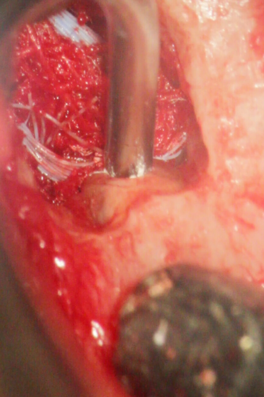 Fig. 4c: (a) Pre-op radiograph with a large periradicular lesion. (b) Periapical surgery. (c) MTA application with the MAP System and PD MTA White. (d) Condensation of the MTA with pluggers. (e) Mirror view of the root-end cavity filled with MTA. (f) Post-op radiograph showing the root-end filling.