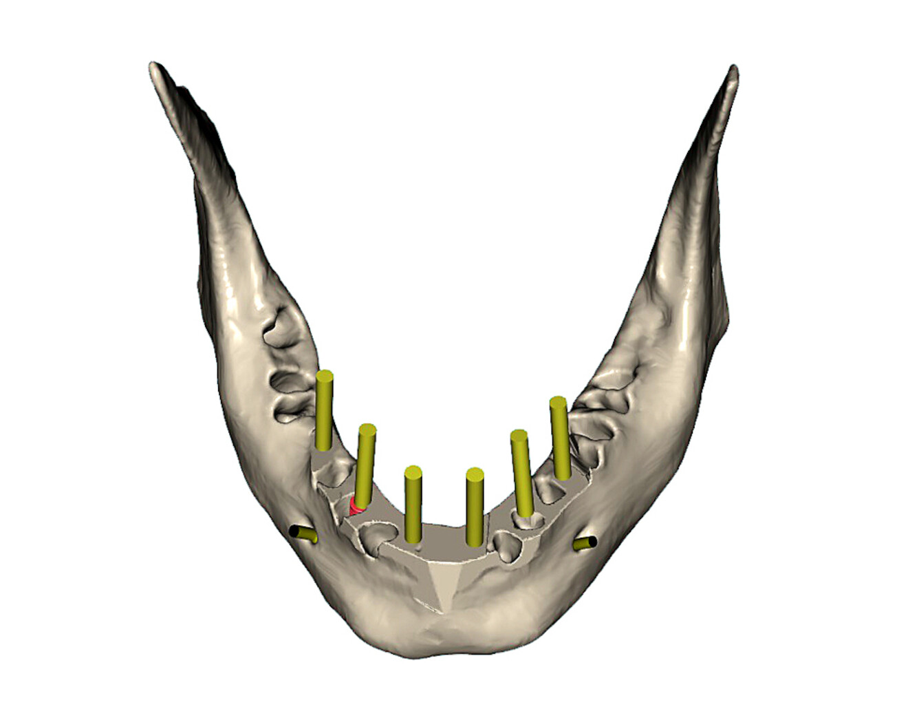 Fig. 14b: Simulation of parallel implants in the mandible with yellow abutment projections