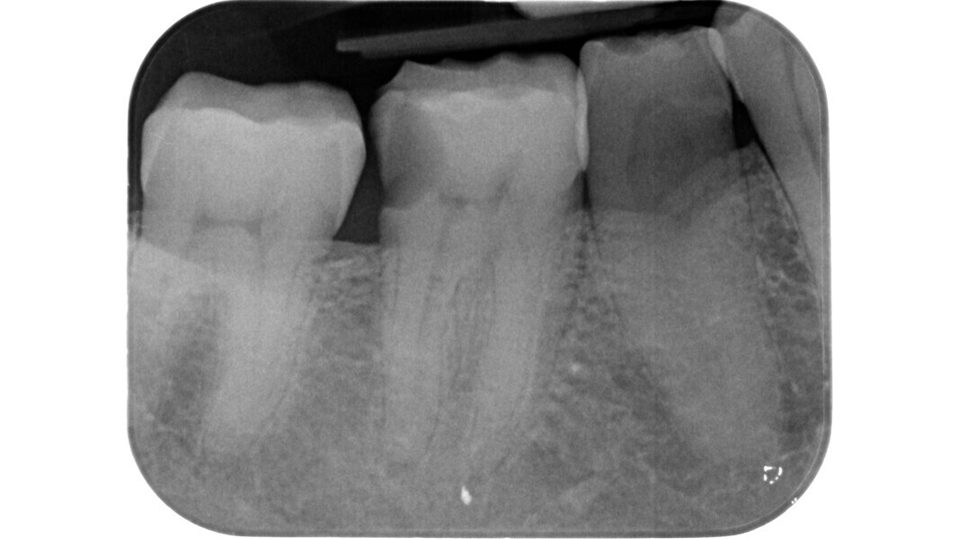 Fig. 15 : Radiographie préopératoire d’une molaire inférieure atteinte de pulpite irréversible.