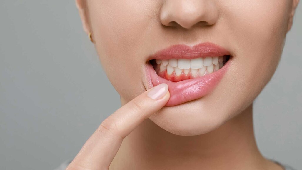 Mikronadelpflaster als neue Parodontitis-Behandlungsmethode?