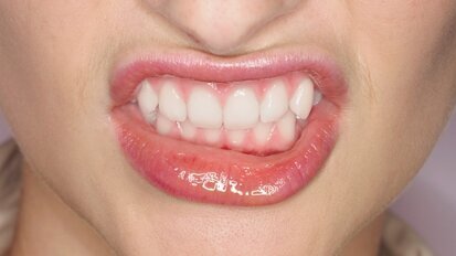 Bruksizm – przyczyny, objawy, leczenie