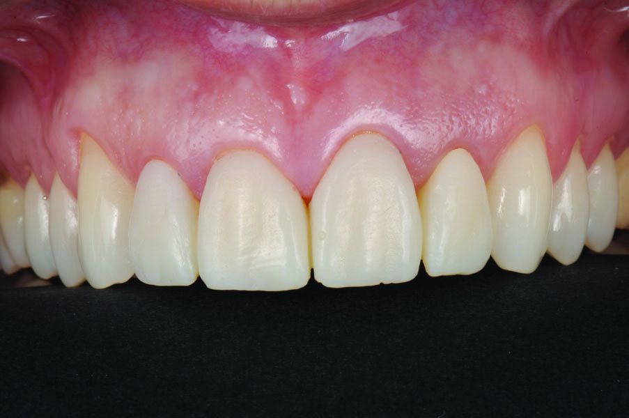 Fig. 20: Final restorations in place.