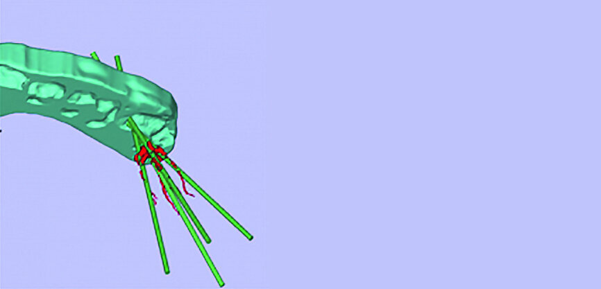 Figs. 11a–c : Depuis la gauche : plan de traitement virtuel pour un accès endodontique guidé par scanner (CT-GEA). La dent à traiter est segmentée par le scanner volumique, des trajets d’accès idéaux sont tracés au travers de la face occlusale de la dent, et un guide de forage CT-GEA est imprimé en 3D.