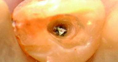 Le retraitement des infections périapicales: chirurgie ou pas ?