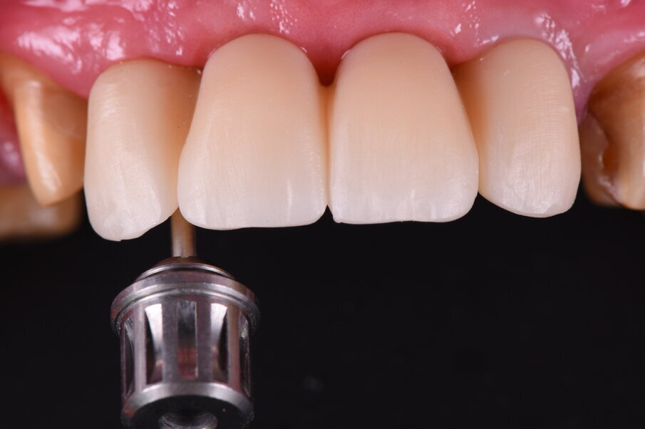 Fig. 42_La passivazione dei monconi è determinante al fine del buon mantenimento strutturale e dell’integrazione osseo-implantare a lungo termine. A tal scopo è richiesta una particolare attenzione tecnica nel confezionamento protesico per tutte le procedure sino al confezionamento ultimo del manufatto protesico. La prova di Sheffield e il controllo radiografico con il centratore consentono di valutare imprecisioni strutturali e di connessione.