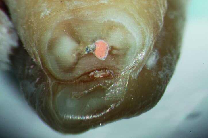 Fig. 2: Oval shaped canal in the apical third of the distal root of a lower molar.