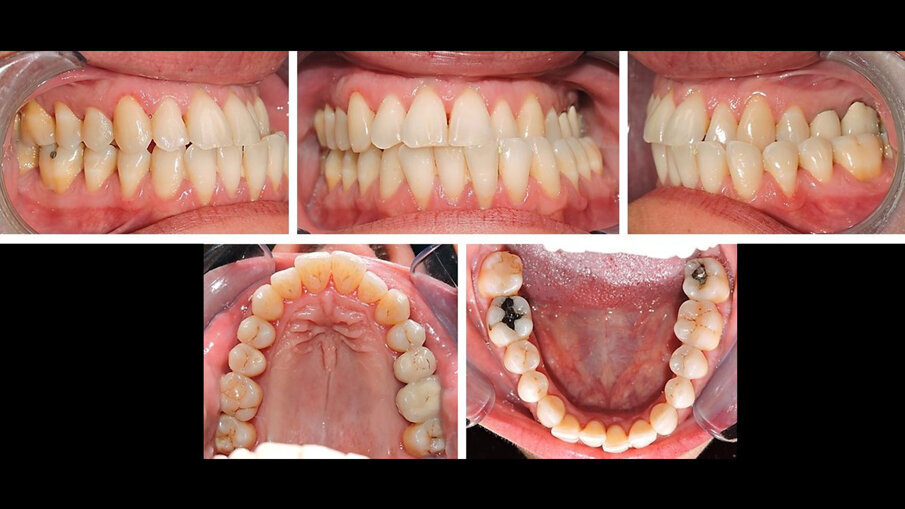 Fig. 2_Immagini intraorali che mostrano una grave deviazione della linea mediana mandibolare sul lato sinistro.