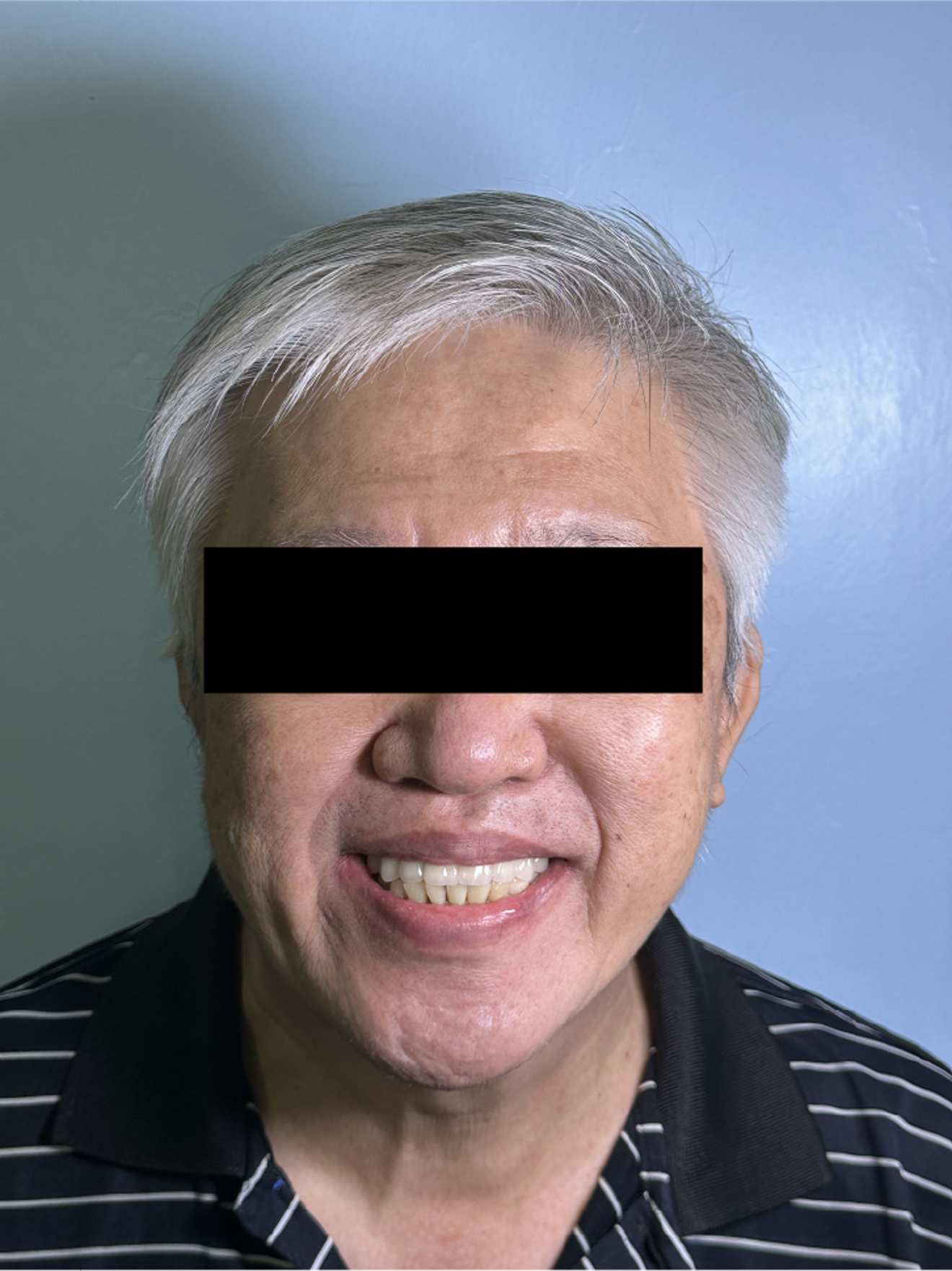 Fig. 3o: Final postoperative smile demonstrating successful full-mouth implant-supported prosthetic rehabilitation with restored function, aesthetics, and occlusal stability