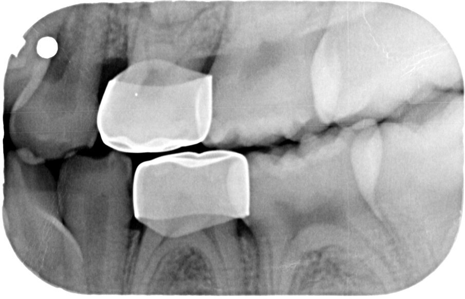Afbeelding 13a-b. Casus 4: 04-03-19. BWR en BWL na 1 jaar in 2 tempi middels de Hall-techniek succesvol zonder spuit, boor of angst behandeld.