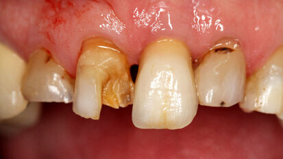 Artigo mostra alta carga global das condições bucais
