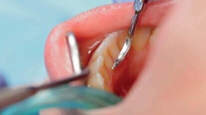 Porównanie efektów laseroterapii ręcznej, ultradźwiękowej i Er:YAG w leczeniu chorób przyzębia