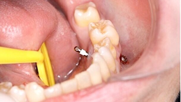 Intrusión de sectores posteriores con microimplantes