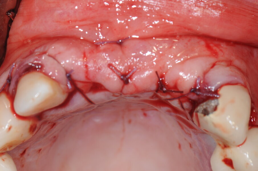 Fig. 12 - Sutura del lembo.