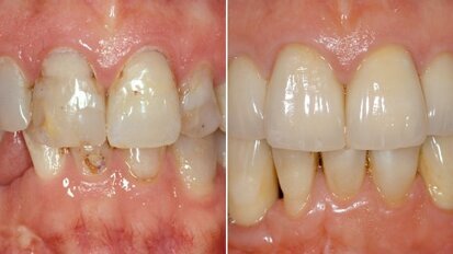 Webinar discusses advanced implant dentistry using digital technology Webinar discusses advanced implant dentistry using digital technology