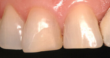 La fluorescencia en restauraciones de resina directa