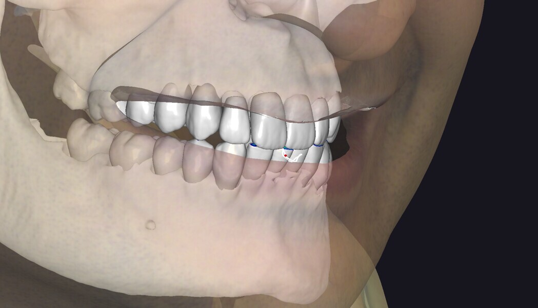 Fig. 4: This close-up shows the digital wax-up in occlusion. The design was dynamically simulated with virtual jaw motion to ensure functional balance alongside aesthetics.